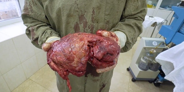 Dr. Dmitry Melnikov holds a lump removed from Tereshin's left tricep.