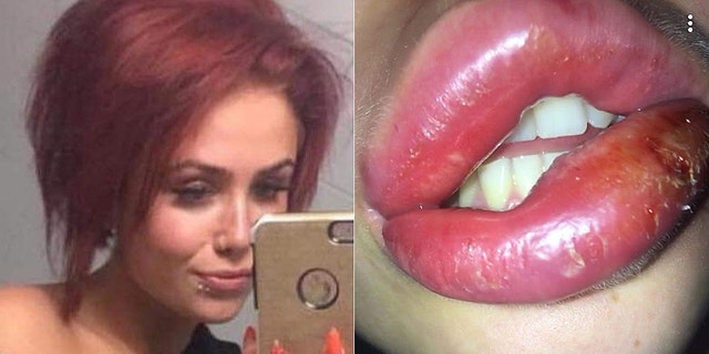 The fillers cost her about $220, plus a week in the hospital and a headache's worth of medical issues. 