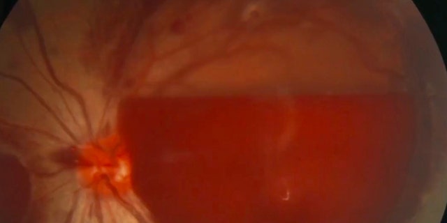 This image shows the burst blood vessel in the woman's eye following hours' worth of phone use.