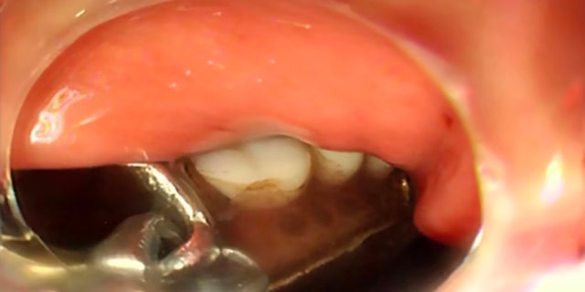 Shang's dentures were located in his digestive tract, which proved difficult to remove without inflicting further damage.
