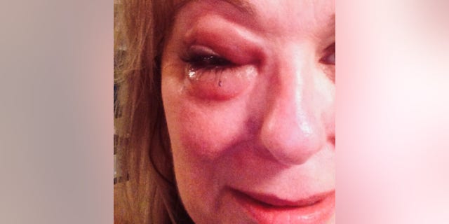 Chief Information Officer of the Tina Stewart Foundation, Allyson Hottinger, after a domestic violence attack.