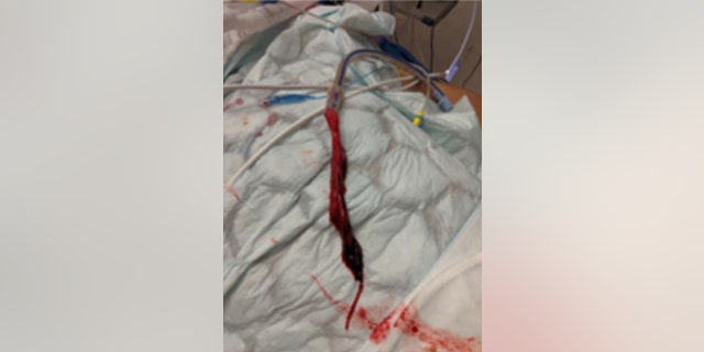 The clot was stuck to the end of his breathing tube, which was then removed from his lung.