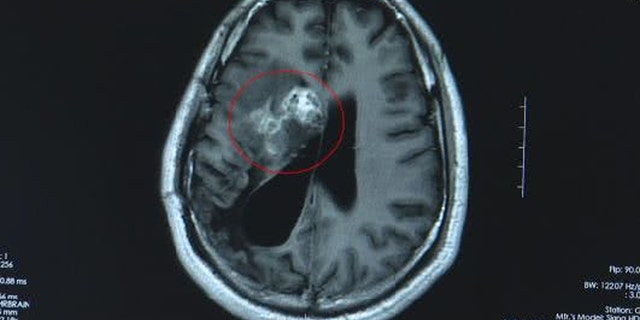 This CT scan shows the tapeworm in Wang's brain.