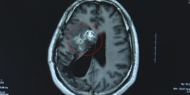 This CT scan shows the tapeworm in Wang's brain.