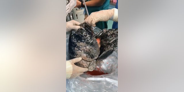 The lungs were heavily damaged by years of tobacco use.