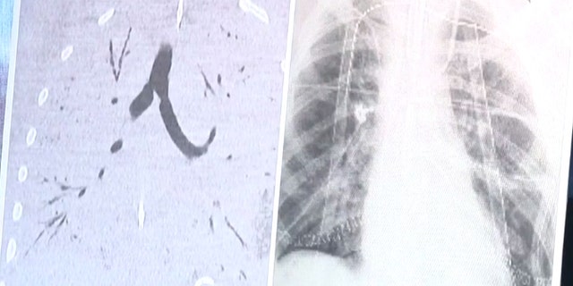 Pictured left are the teens severely damaged lungs filled with damaged tissue.