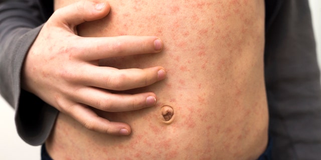 The 82 measles cases in Franklin County, Ohio, make up the bulk of the nation's 117 reported cases.