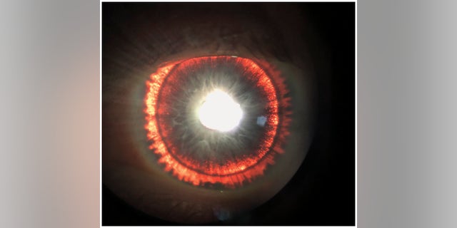 The man's eye appeared to "glow" because of a condition called pigment dispersion syndrome.
