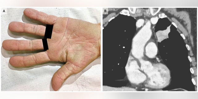 The woman's palms had a "velvety" appearance due to a rare condition linked to some cancers.