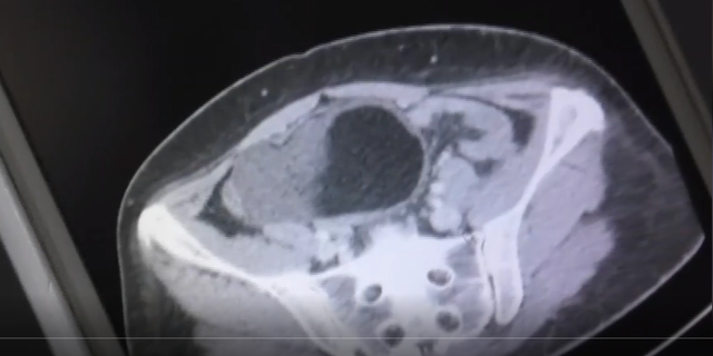 A scan of the woman's cyst.