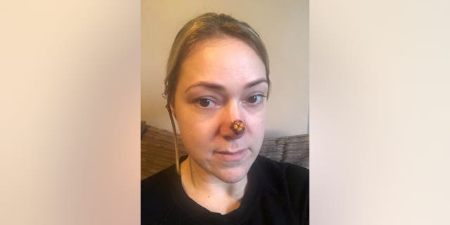 On Nov. 5, she underwent a skin graft to remove the spot and said that her son was scared of her new look.