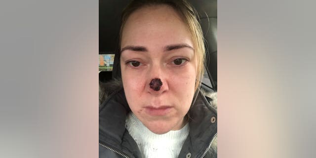 She had the sponge removed today, and said while her confidence has taken a hit she wants to share her story in a bid to warn others about the dangers of skin cancer.