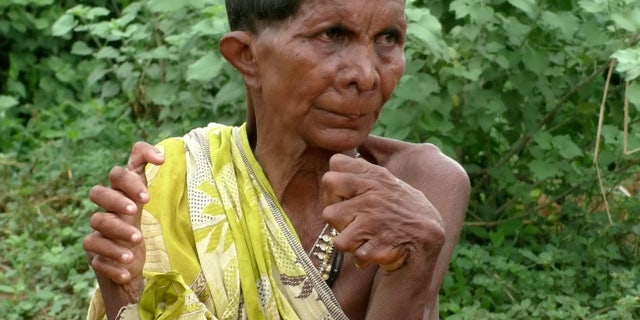 Kumar Nayak, 63, from the Ganjam district in Odisha, India, said her family was too poor to seek treatment.