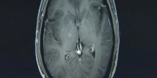 The tapeworms, seen above in a scan of Zhu Zhonfa's brain, entered his body through his digestive system after he ate undercooked pork.