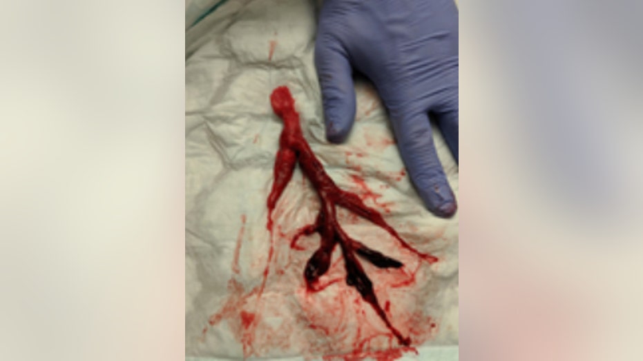 Doctors Remove 8 Inch Blood Clot In Shape Of Bronchial Tube From Doctors Remove 8 Inch Blood Clot In Shape Of Bronchial Tube From