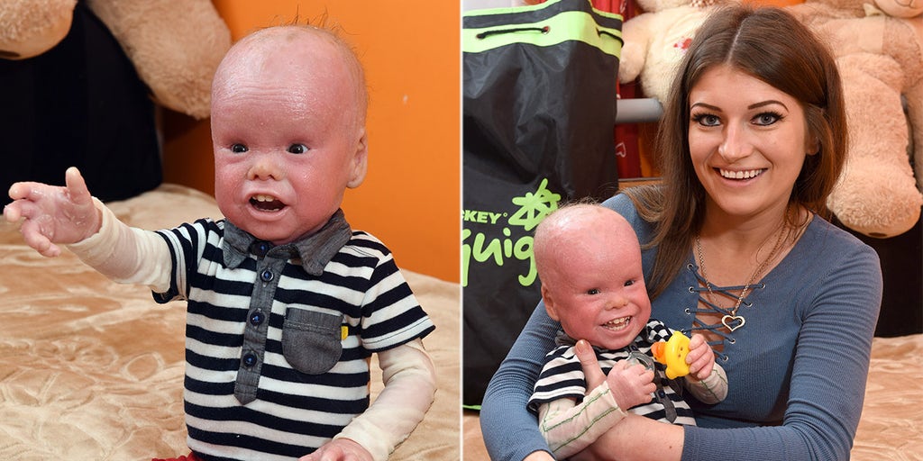 Boy 2 Has Rare Scale Like Skin Condition That Affects 1 In 500 000 He S Overcome So Much Fox News