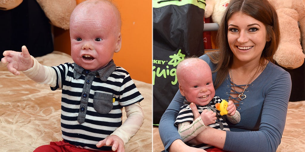 Boy 2 Has Rare Scale Like Skin Condition That Affects 1 In 500 000 He S Overcome So Much Fox News Boy 2 Has Rare Scale Like Skin Condition That Affects 1 In 500 000 He S Overcome So Much Fox News