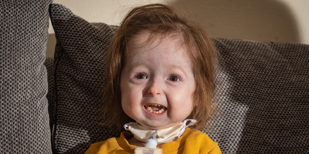Girl 2 With Rare Form Of Benjamin Button Disease Weighs Just