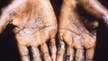 Monkeypox in US: CDC monitoring 200 people in 27 states, other countries