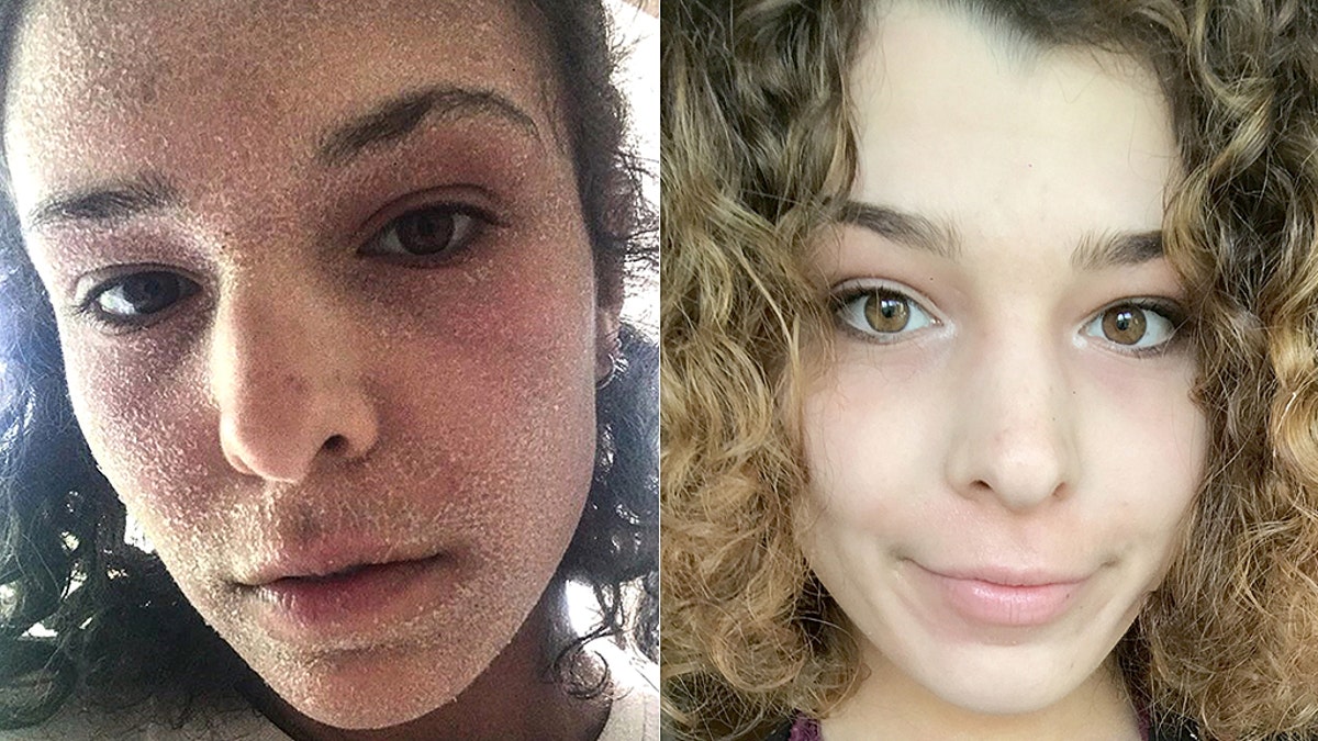 Alice Burleigh before she stopped using steroid-based creams (L) and the 23-year-old today (R).