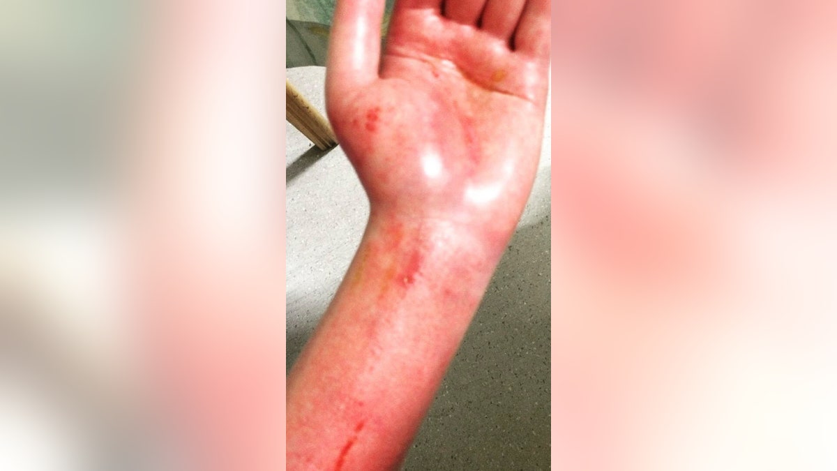 Snell said the accident caused her to start suffering from Complex Regional Pain Syndrome (CRPS) and after 12 months of hospital appointments, her condition worsened.