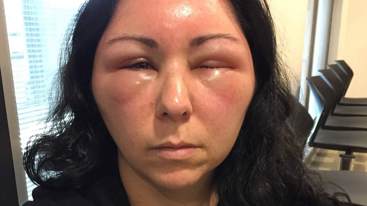 Within days of using hair dye, her head had swelled so much that she couldn't open her eyes.