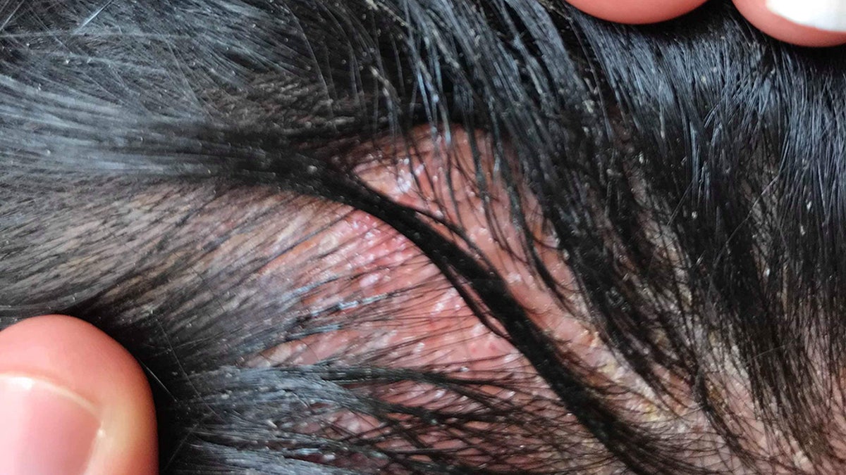It took three weeks for the swelling, itching and burning to subside.