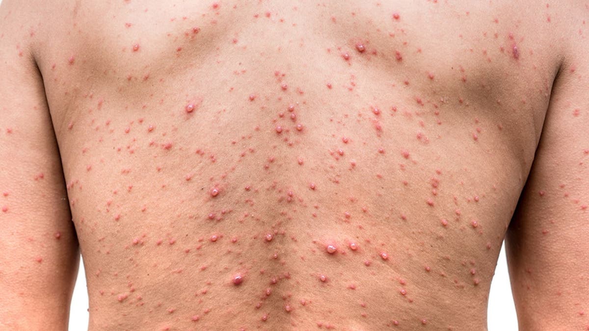 The outbreak of chickenpox occurred at an elementary school in Wisconsin.