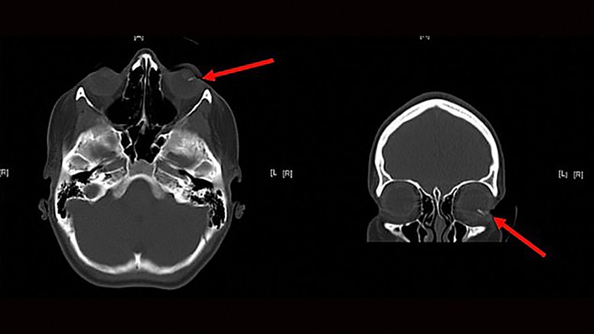 A scan showing where the lead entered the girl's eye.