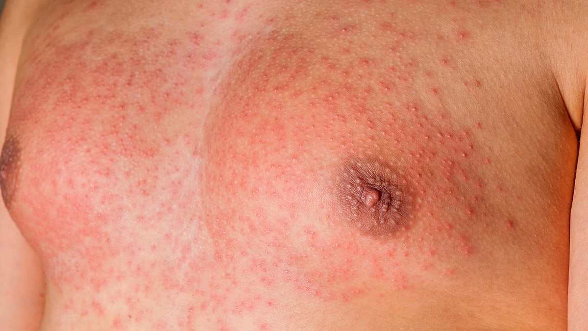 Scarlet fever causes a bright red rash.