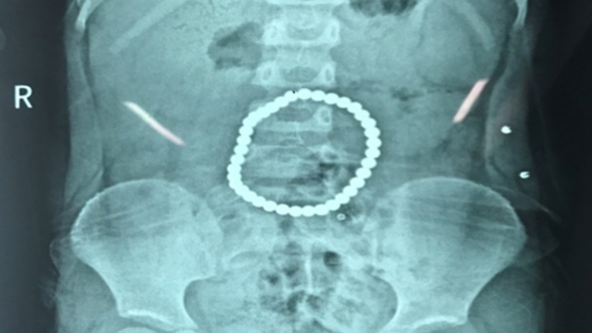A scan revealed that the balls had connected in her stomach to form a perfect circle. 