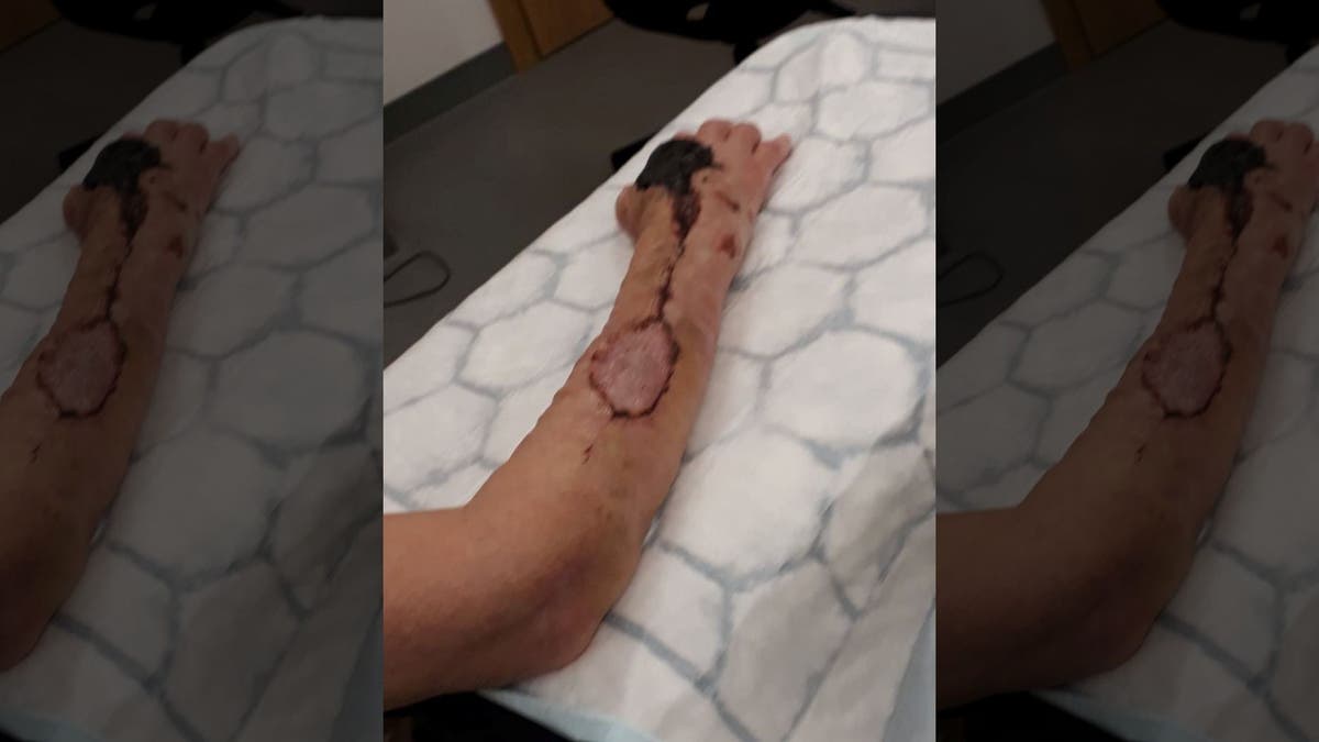 The woman's arm as she battled flesh-eating bacteria.