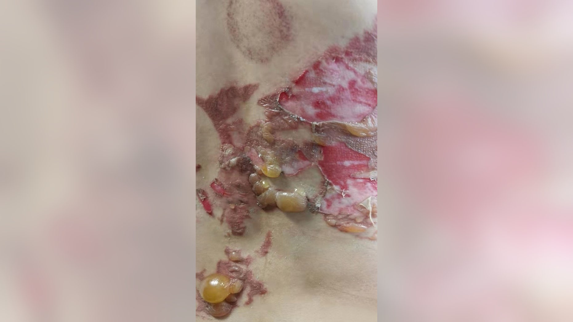 The rubbing alcohol on her skin caught fire, leaving her with bloodied, blistered scars. (AsiaWire)