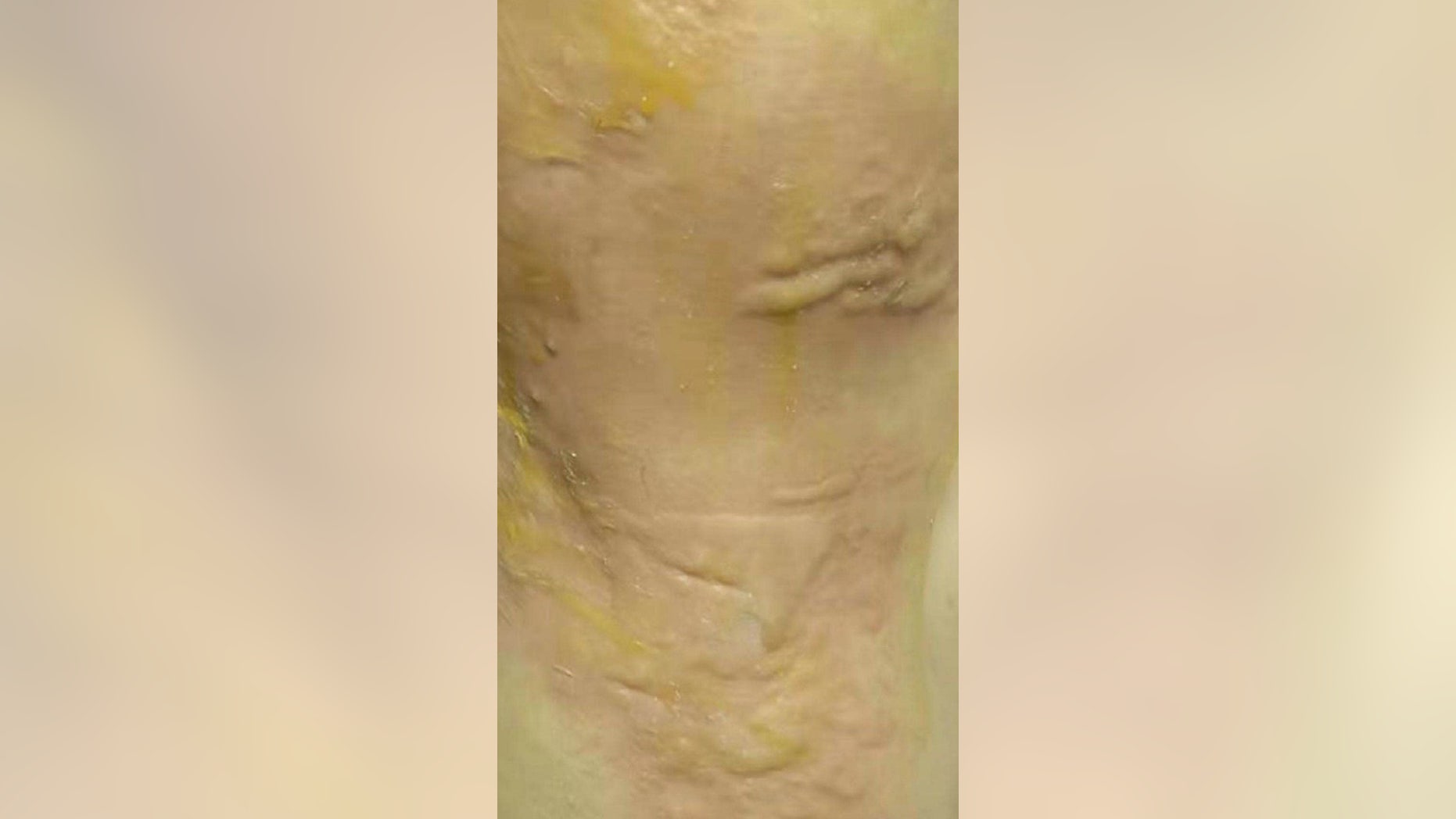 She may suffer permanent scarring as a result, reports say. (AsiaWire)