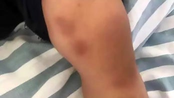 Toddlers with unexplained bruising had 'pork tapeworm' larvae in bodies