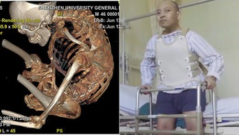 Man living bent in half has spine broken and rebuilt in 4-part surgery