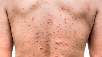Wisconsin elementary school sees chickenpox outbreak: health officials