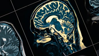 1 in 4 people with Parkinson’s disease misdiagnosed, given wrong treatment, study claims