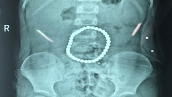 Toddler left with holes in stomach after swallowing 37 magnetic balls, report says