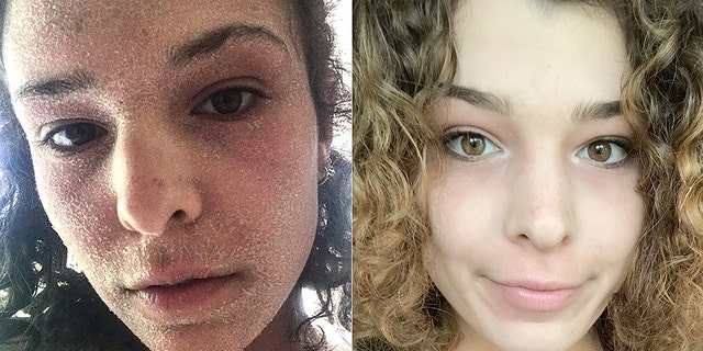 Alice Burleigh before she stopped using steroid-based creams (L) and the 23-year-old today (R).