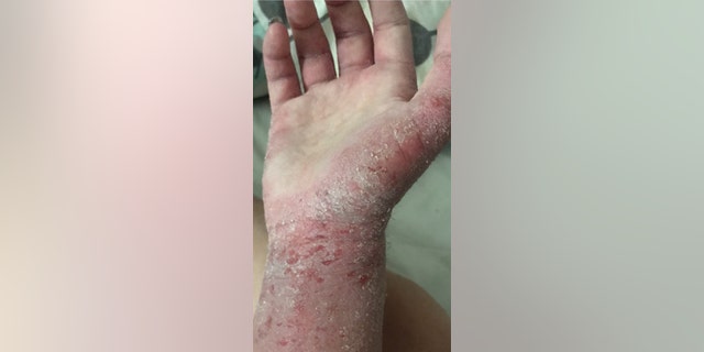 Alice Burleigh's arm when she was dealing with a bad bout of eczema.