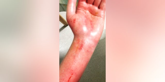 Snell said the accident caused her to start suffering from Complex Regional Pain Syndrome (CRPS) and after 12 months of hospital appointments, her condition worsened.