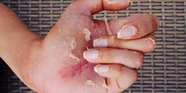 Snell then developed a fever and started vomiting, which is when doctors discovered she had developed sepsis.