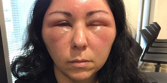 Within days of using hair dye, her head had swelled so much that she couldn't open her eyes.
