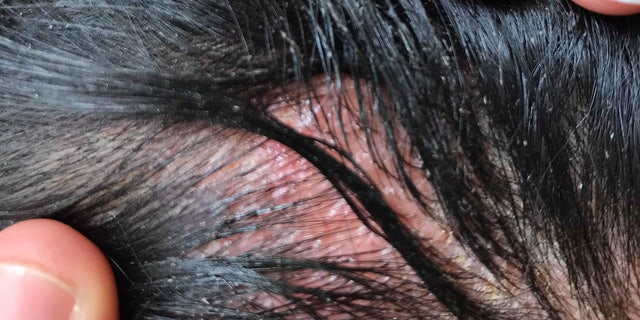 It took three weeks for the swelling, itching and burning to subside.