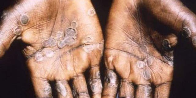 Case of monkeypox confirmed in England after patient had traveled to