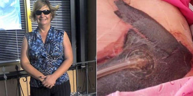 Just days after the operation, the 53-year-old said the flesh around her wound began to rot, and turned black.