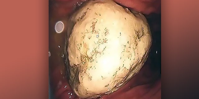 The mass was 2-inches in size and was causing the woman severe pain.
