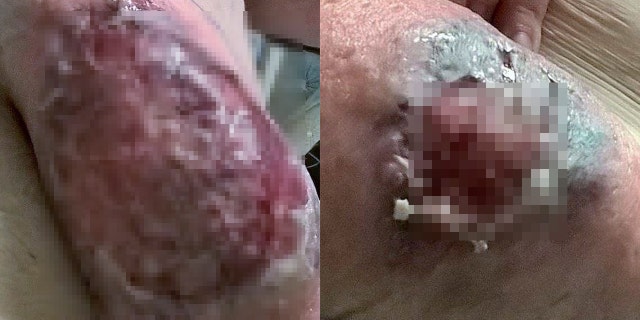 Michalski's sores vary in size and have caused her to stress about what the future holds.