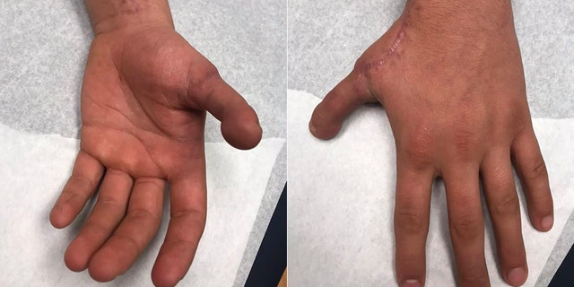 Aiden Adkins shows off his new thumb.